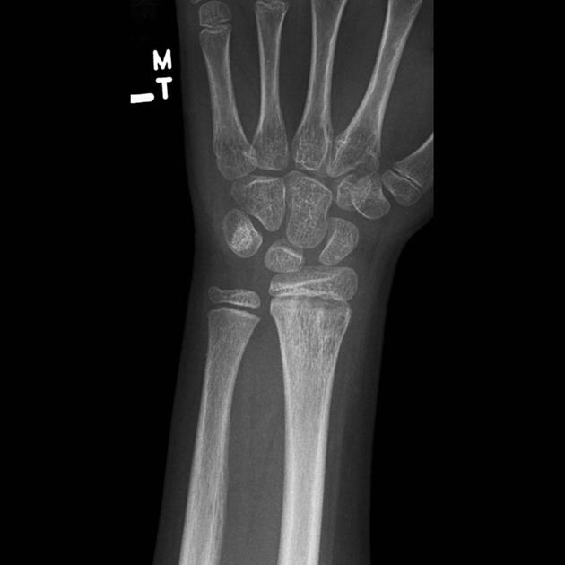 рентгенограмма остеомиелита лучевой кости