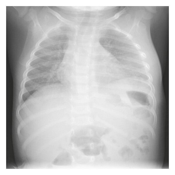 рентгенограмма остеомиелита рёбер 