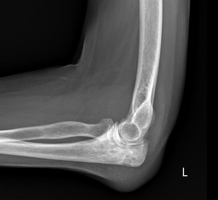 рентгенограмма остеомиелита локтевой кости