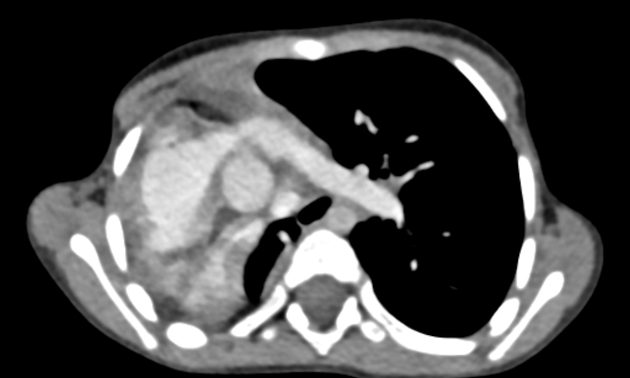 гипоплазия легких на КТ