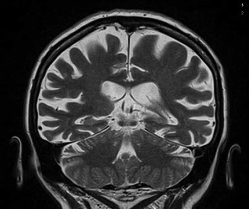 Focal cortical atrophies