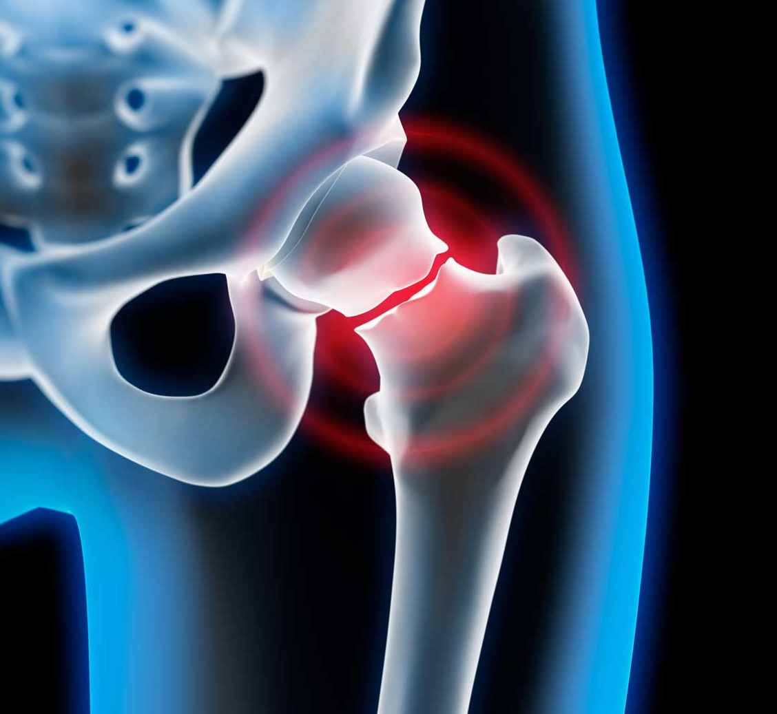 Ранняя диагностика перелома шейки бедра - симптомы, причины, обследования