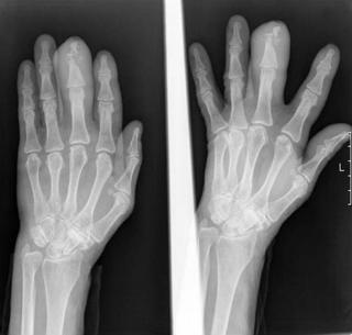 Остеомиелит ногтевой фаланги пальца