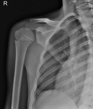 Остеомиелит плечевой кости на рентгене