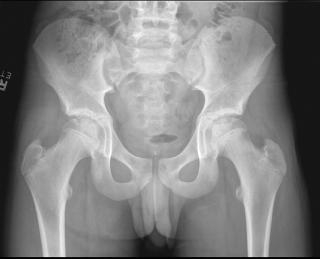 Остеомиелит шейки бедренной кости рентгене