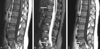 Остеомиелит позвоночника