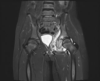 Остеомиелит костей таза